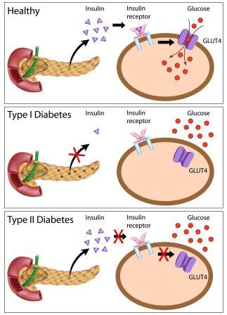 diabetes