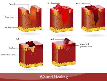 wound healing