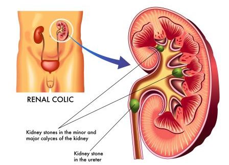 kidney stones