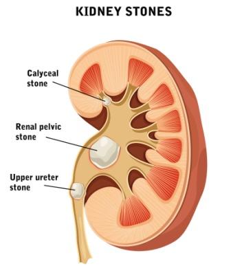 renal calculi