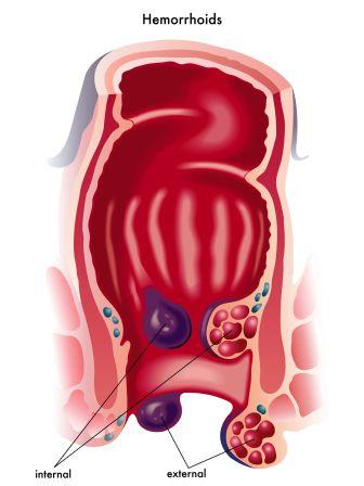 Internal and external hemorrhoids