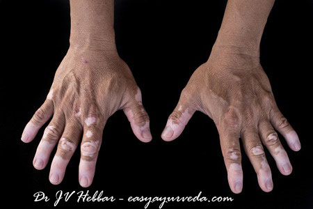 Vitiligo Ayurveda