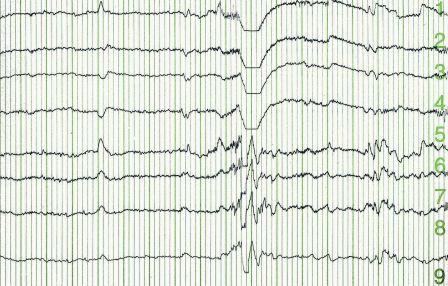 Epilepsy - EEG