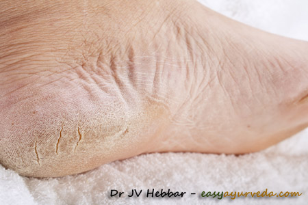 How to Heal Cracked Heels and Feet