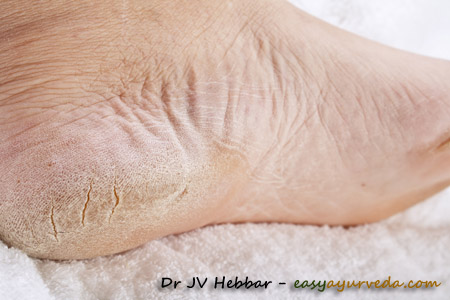 Diabetic foot problems: Symptoms, treatment, and foot care