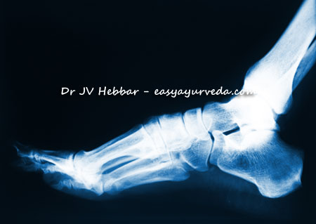 calcaneal spur Ayurveda