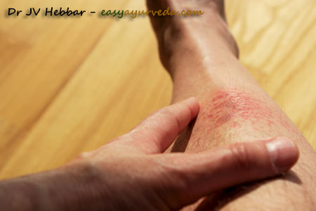 eczema on legs