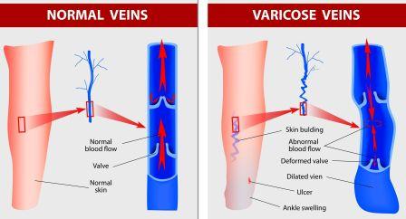 Normal vein Vs Varicose vein