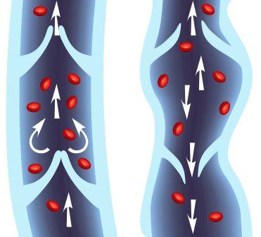 Swollen varicose vein