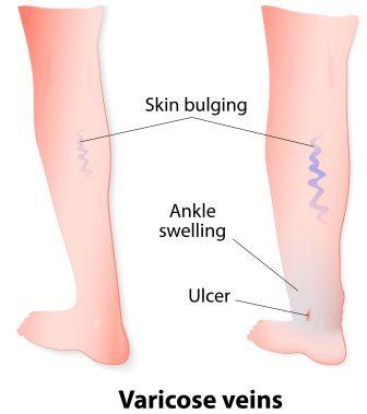Varicose vein symptoms and stages