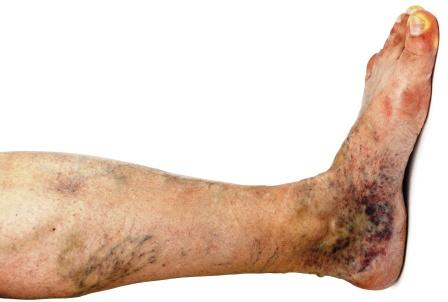 Varicose veins in foot and leg