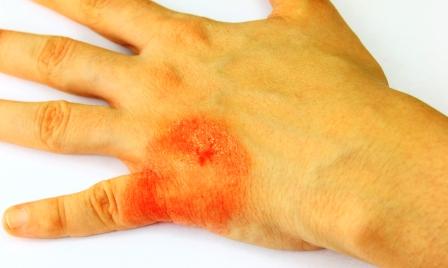 Tinea manuum