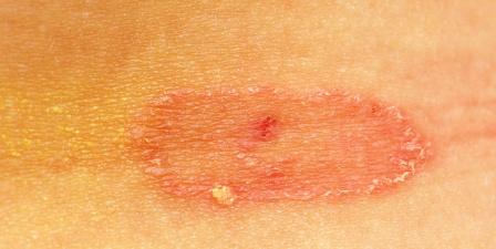 Tinea versicolor
