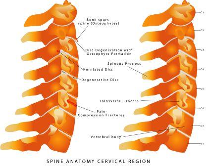 Normal neck bones versus cervical spondylosis