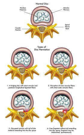 cartilage disc deneration and herniation