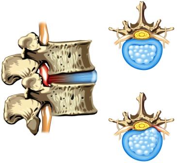 HERNIA OF THE DISC - SLIPPED DISC