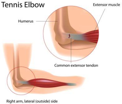 Tennis elbow explanation