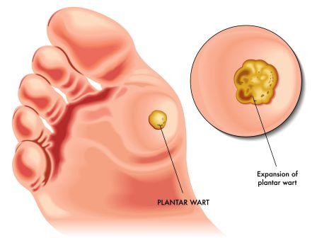 Plantar wart