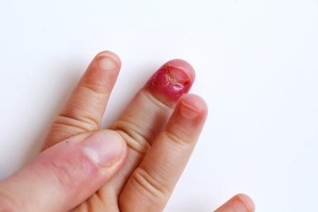 One of my fingernails is swollen. What might be the cause? - Quora