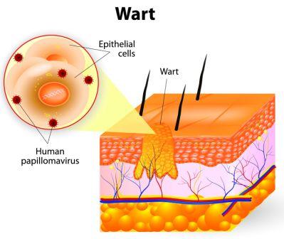 wart anatomy