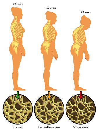 Osteoporosis in women