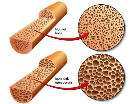 Osteoporosis - low bone density