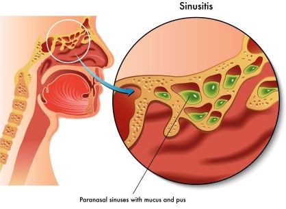sinusitis with mucus