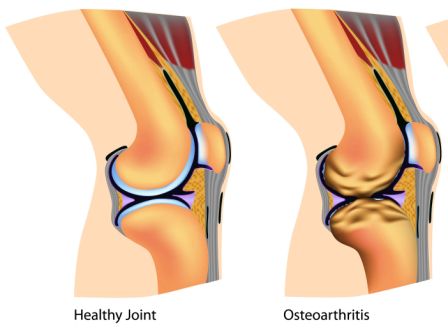 arthritis of knee joint