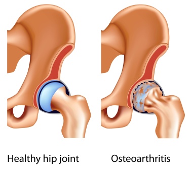 osteo arthritis of hip
