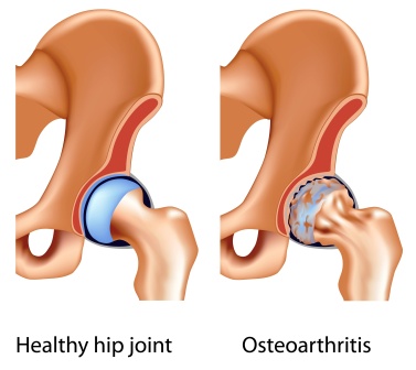 Hip Pain Treatment in Aluva - Physical Treatment - Maana Health