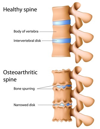 osteo arthritis of spine - back