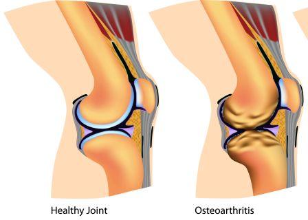 osteo arthritis