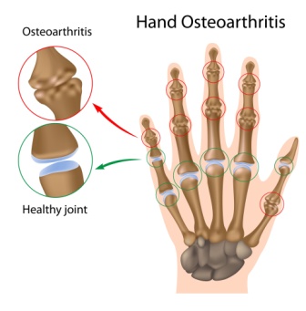 osteoarthritis - hand