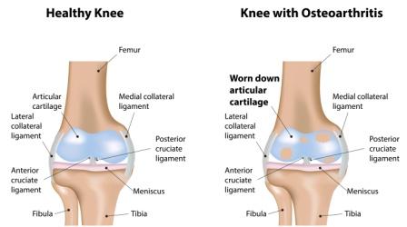 osteoarthritis of knee joint