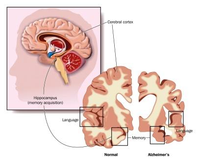 alzheimer, dementia brain changes