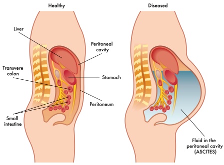 ascites