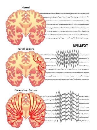 Epilepsy EEG