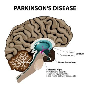 Parkinsons disease pathology