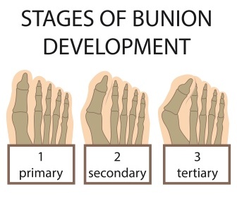 Bunion