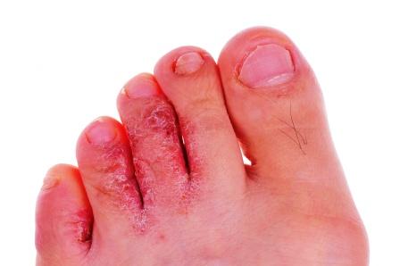 athletes foot