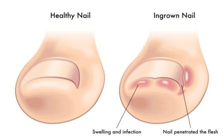 ingrown nail