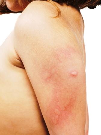 allergic skin rash, hive