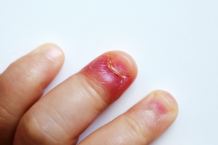 Nail Trauma | Podiatry Centre in Singapore