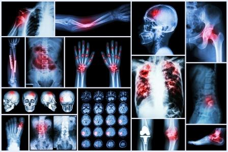 fracture, dislocation cva