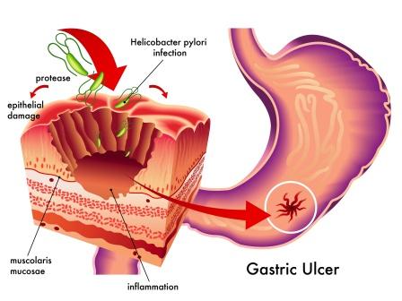 gastric ulcer