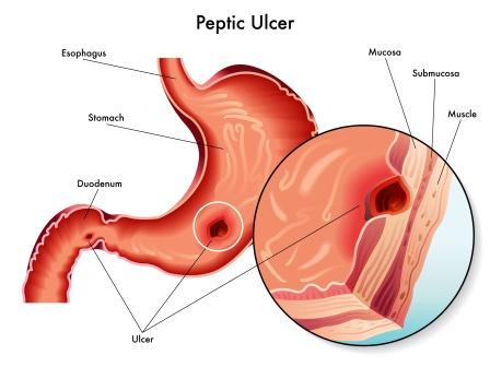 Daily Routine to Avoid Stomach Ulcers - Nirvana Naturopathy & Retreat