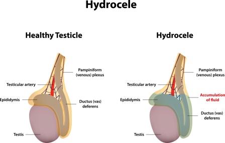 hydrocele testicular testis testicle treatment hydroceles hernia fluid sac newborn symptoms man men baby scrotum testicles surgery causes prevention elderly