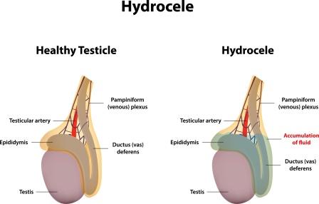 Hydrocele