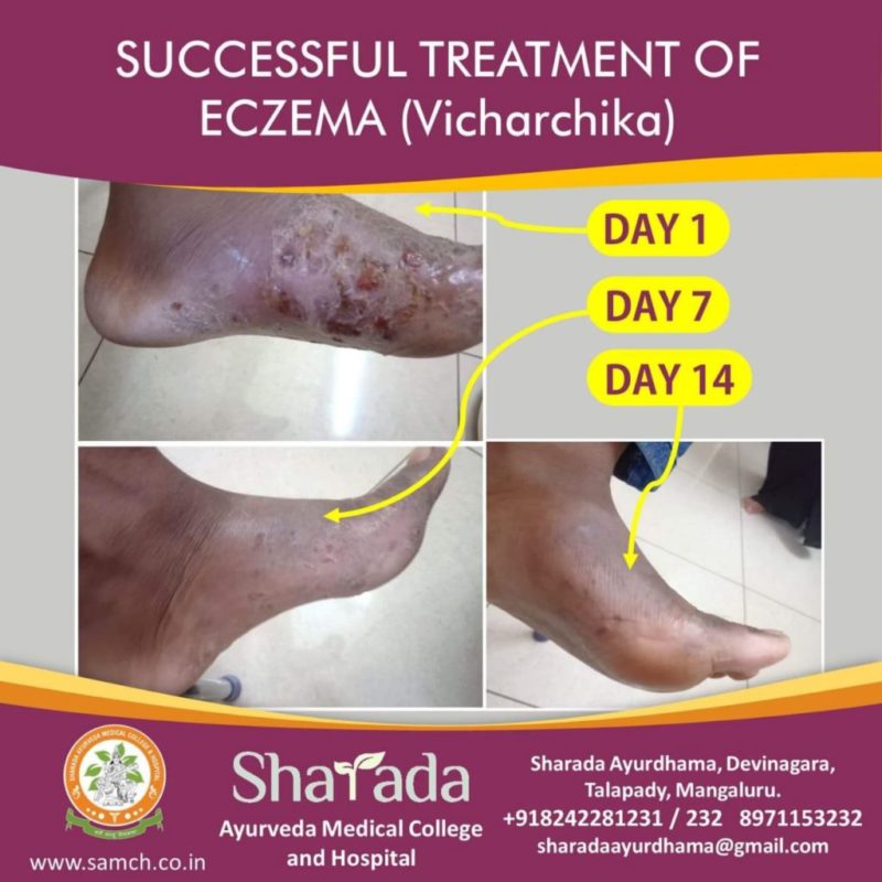 Recurrent skin infection in same spot image